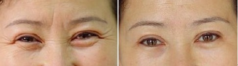 眼角除皺——張女士