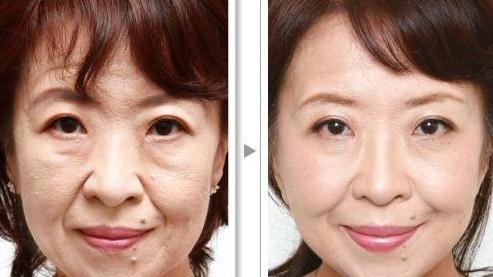 面部除皺——謝女士