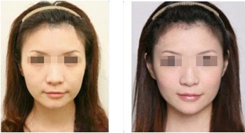 注射除皺——劉女士