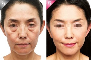 注射去除魚(yú)尾紋——武女士