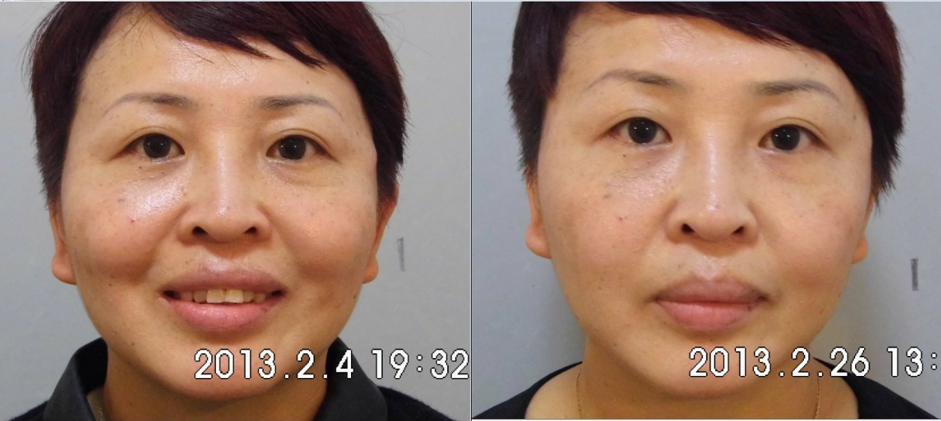 PRP活性因子面部種植——馬女士