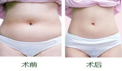吸脂術(shù).jpg
