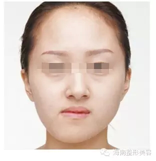下巴骨歪斜.webp.jpg