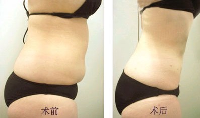 腹部吸脂——?jiǎng)⑴? /></a></div>
                        <span><h1><a href=