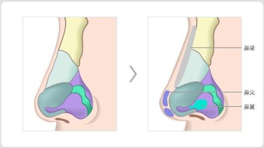 隆鼻-林賢超醫(yī)生