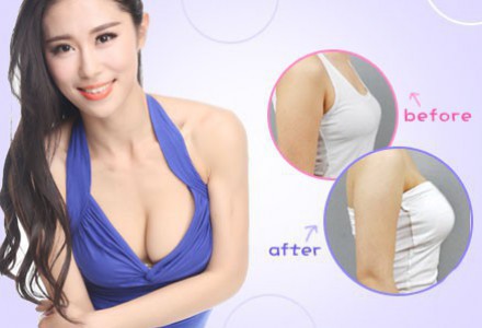 隆胸案例-林賢超醫(yī)生