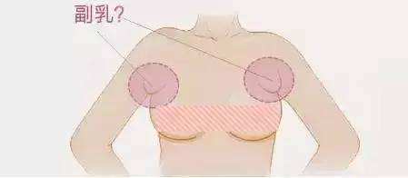 切除副乳.jpg