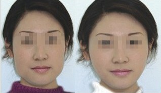 下頜角整形——馬女士