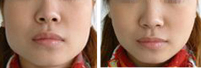 微動力微孔改臉型——鄭小姐