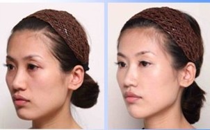 彩光嫩膚——陳女士