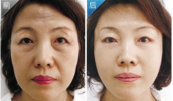 手術除皺——張女士