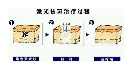 激光治斑.jpg