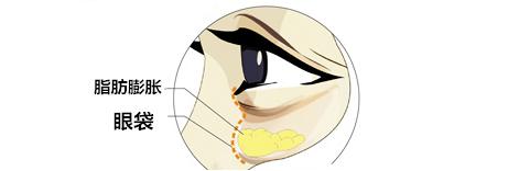 抽脂祛眼袋.jpg