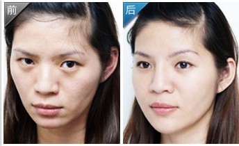 面部填充——周小姐