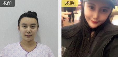 駝峰鼻矯正對比.jpg
