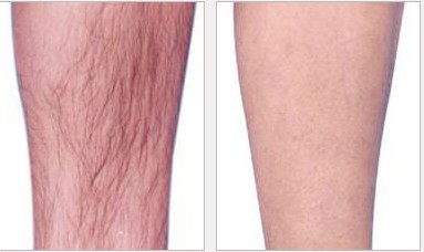 小腿冰點(diǎn)脫毛——?jiǎng)⑾壬? /></a></div>
                        <span><h1><a href=