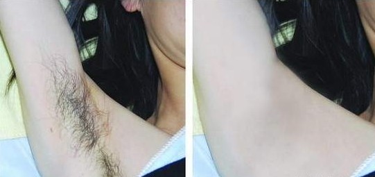腋下冰點(diǎn)脫毛——甄女士