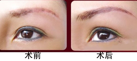 眉部整形——陳小姐