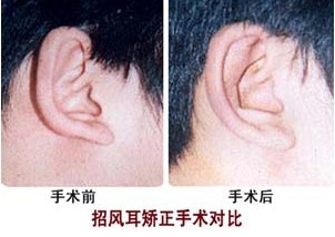 招風(fēng)耳矯正術(shù)——李先生