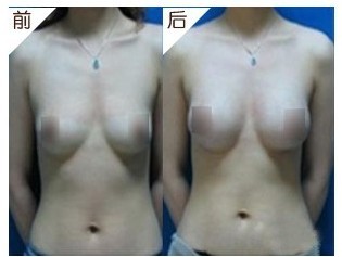 水滴形假體隆胸——劉小姐