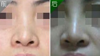 隆鼻手術(shù)失敗修復——劉小姐