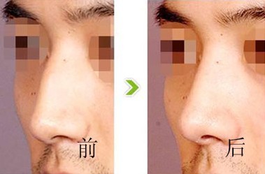 隆鼻失敗修復——李先生