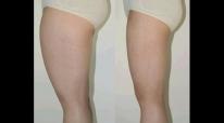 腿部吸脂——-張小姐