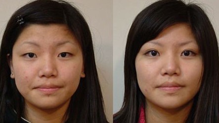 韓式重瞼術(shù)——錢女士