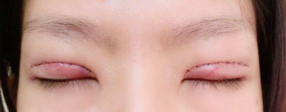 雙眼皮修復.jpg