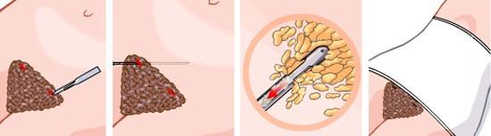 腰部吸脂-林賢超醫(yī)生